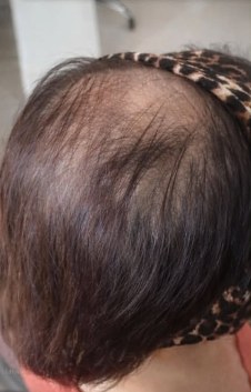 Antes do tratamento capilar feminino